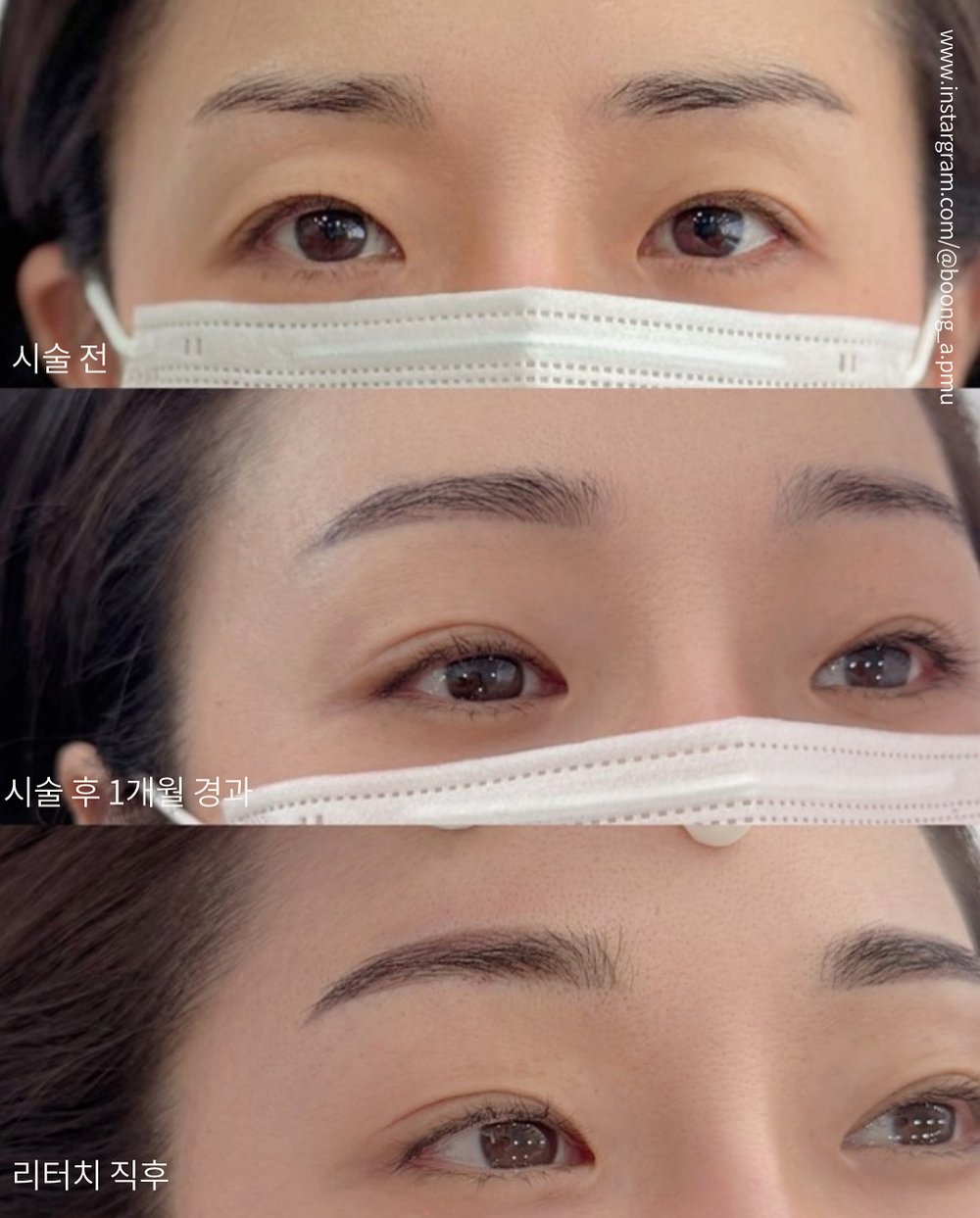 시술 전, 시술 후 1개월, 리터치 직후를 비교한 자연눈썹 결과